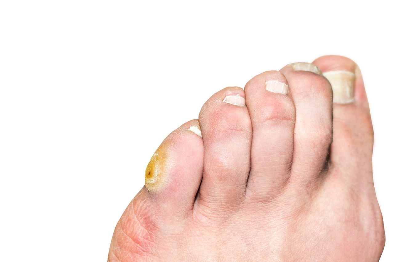 Inflamed corn on toe online